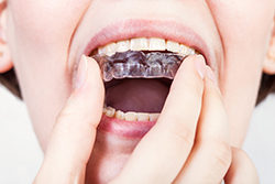 Clear Aligners - Orthodontist in Tempe